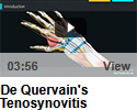 De Quervain's Tenosynovitis