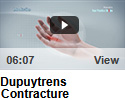 Dupuytrens Contracture