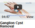 Ganglion Cyst Removal