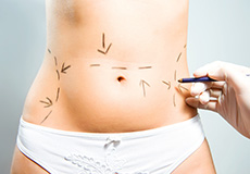 Abdominoplasty