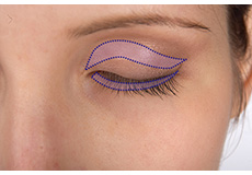 Blepharoplasty