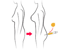 Buttocks Lift and Augmentation with Autologous Fat Transfer