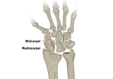 Carpal Instability