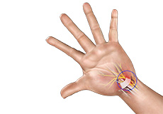 Carpal Tunnel Syndrome