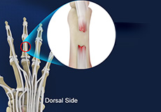 Extensor Tendon Injuries