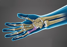 Fractures of the Hand and Fingers