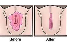 Labiaplasty