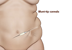 Lipoabdominoplasty