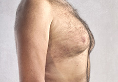 Male Gynecomastia