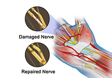 Nerve Repair