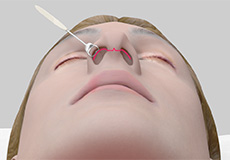 Open Rhinoplasty