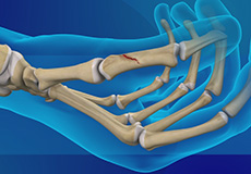 Thumb Fracture